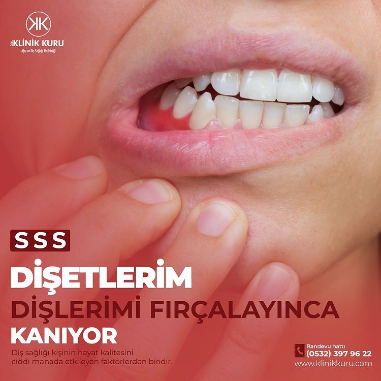 Dişetlerim Dişlerimi Fırçalayınca Kanıyor