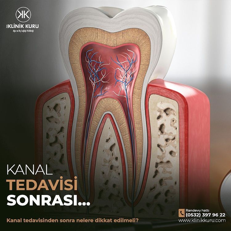 Kanal Tedavisi Sonrası